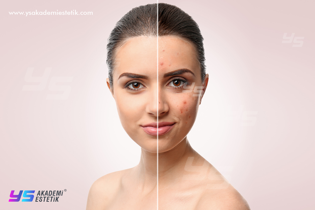 akne tedavisi pendik